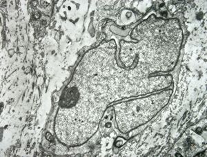 F,12y. | malignant schwannoma v.s. … neurofibrosarcoma ?